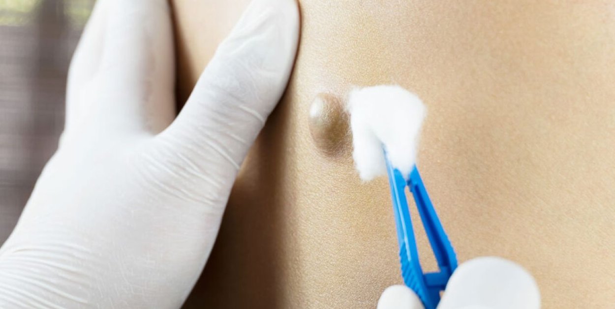 Torbiel włosowa – mechanizm powstawania i znaczenie leczenia